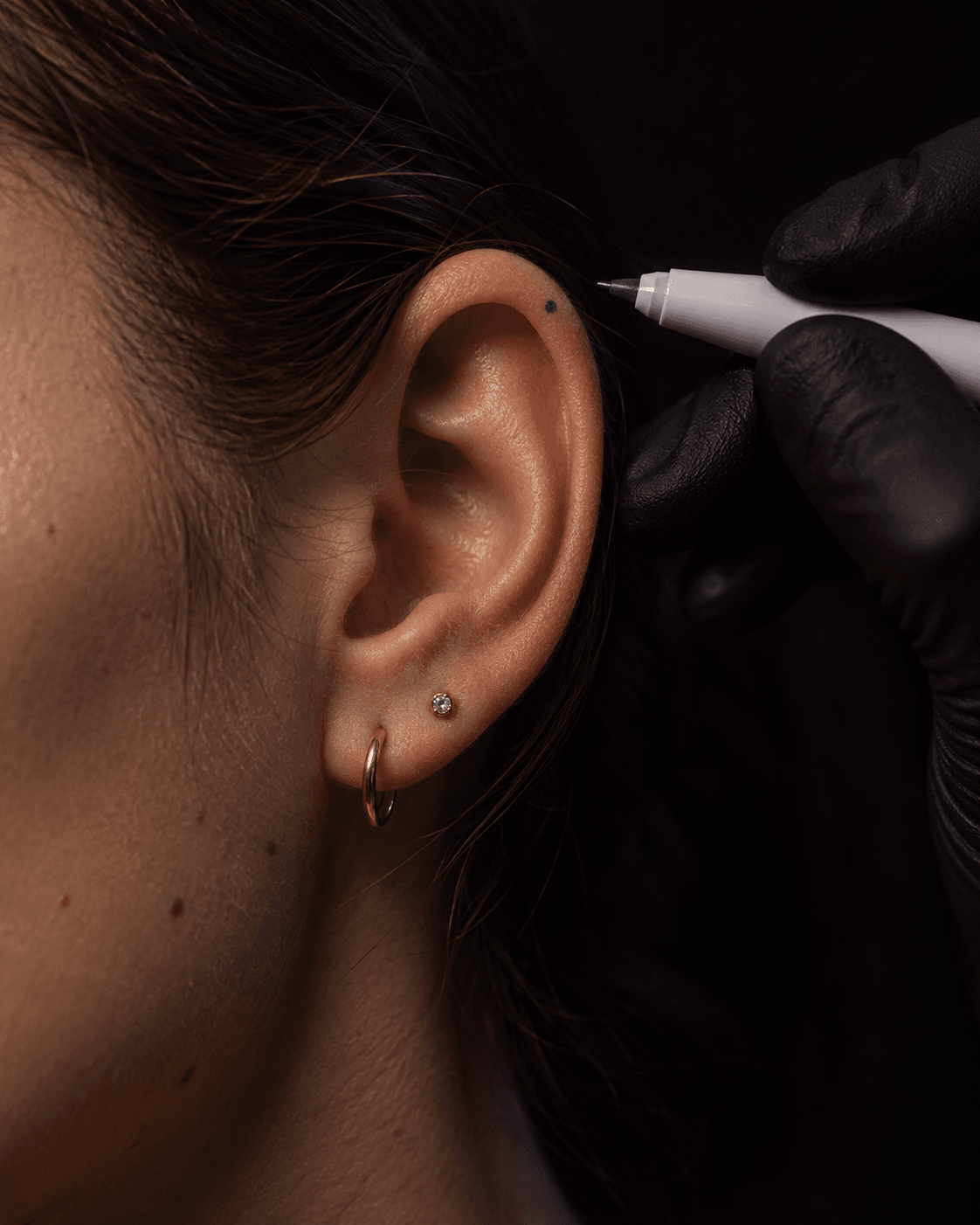 Marcação precisa com caneta cirúrgica na orelha antes do procedimento.